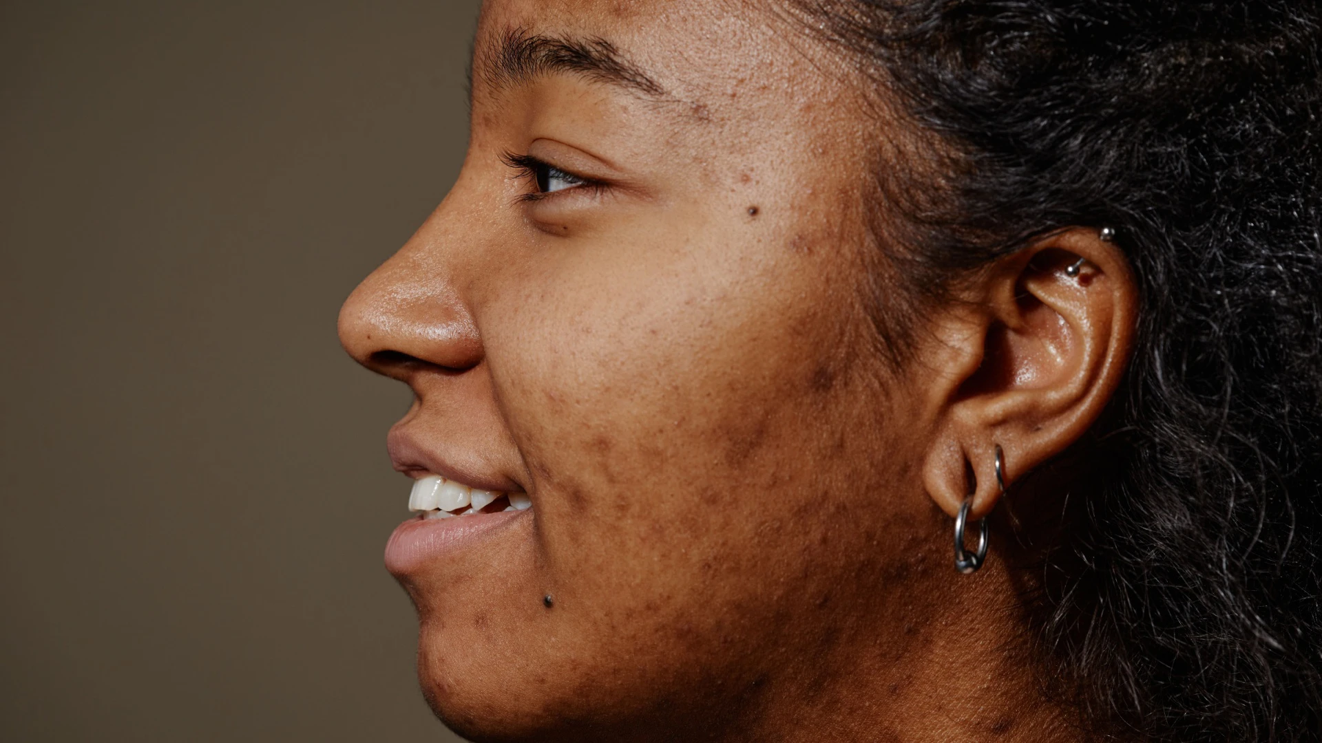 Acne & Acne Scarring - Aesthetic Care Center Aesthetic Care Center