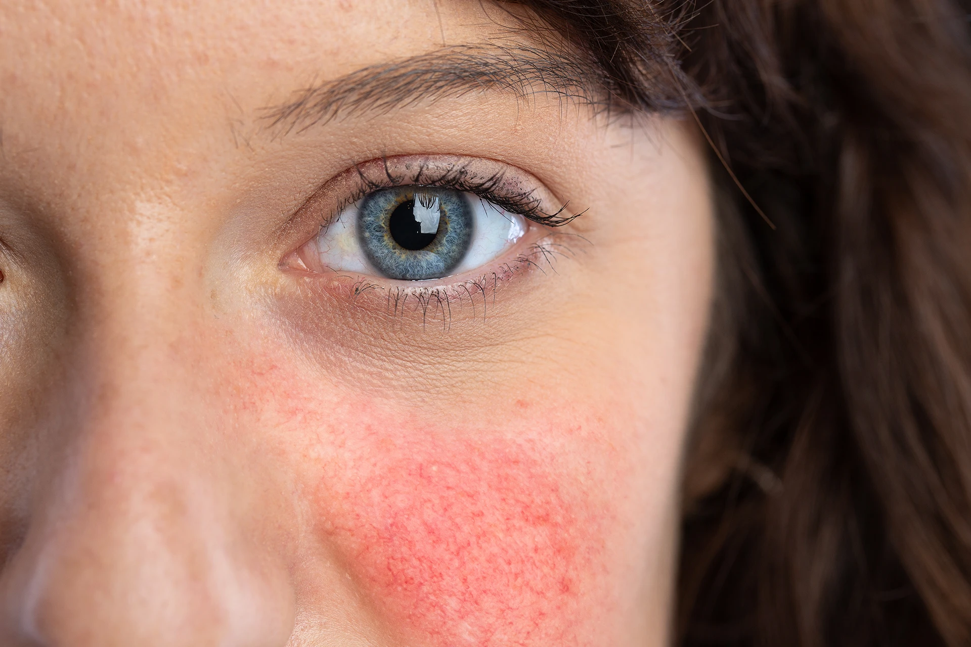 Meta Rugelj Minocycline & Metrogel - Aesthetic Care Center Aesthetic Care Center
